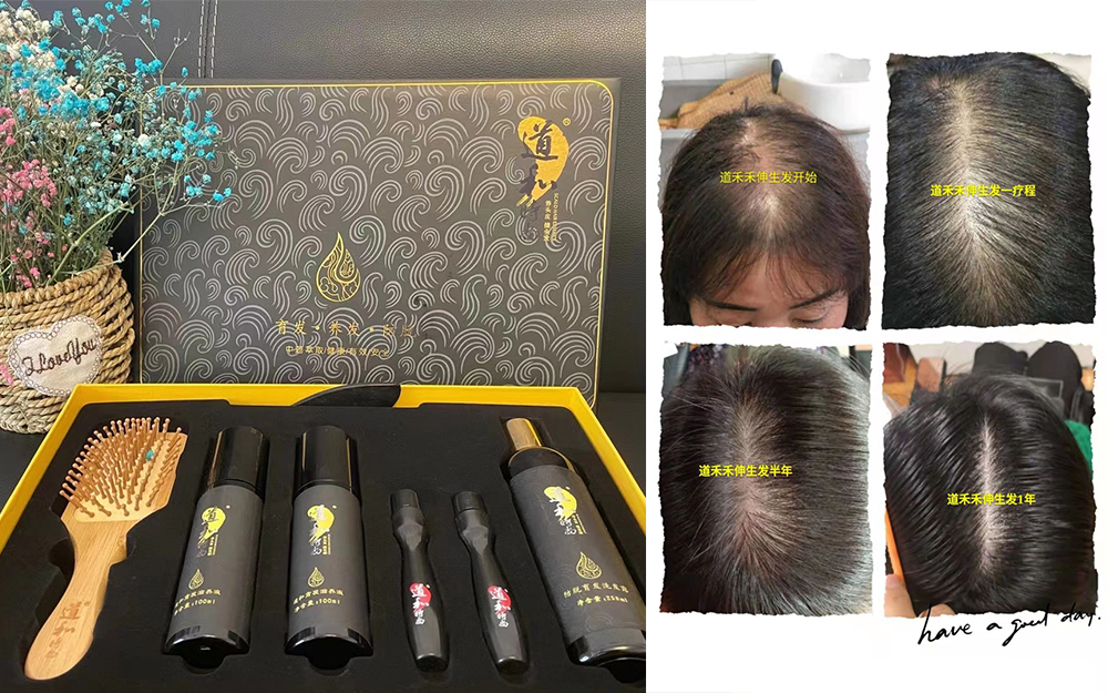 男性脫發(fā)的種類與原因
