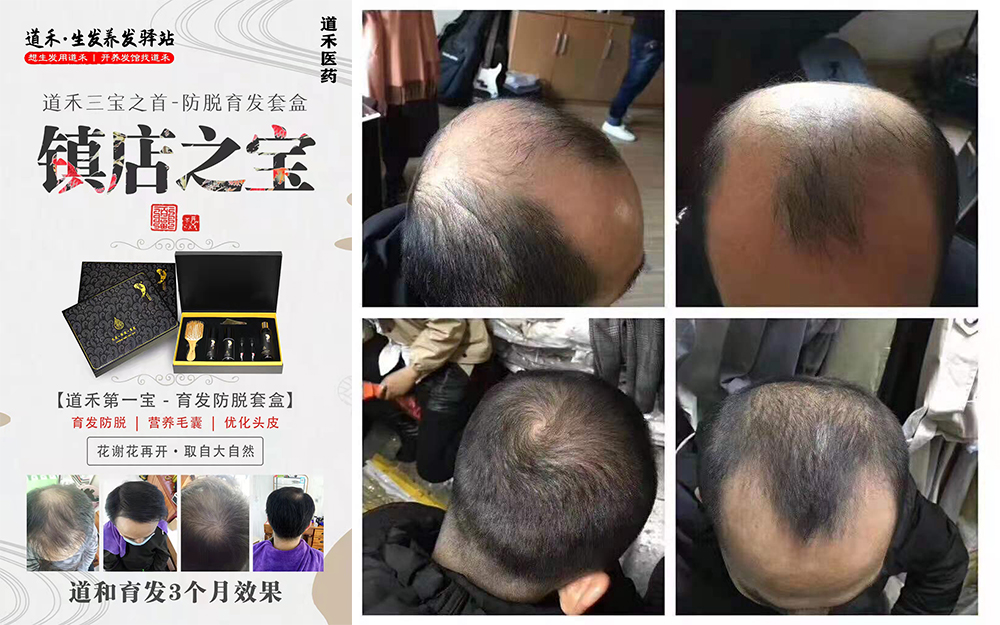 道禾生發(fā)三個(gè)月效果